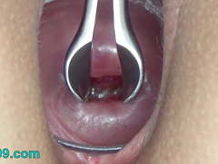 Cervix stretching wide with speculum and sperm in uterus